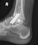 Arthrodesis nonunion lateral